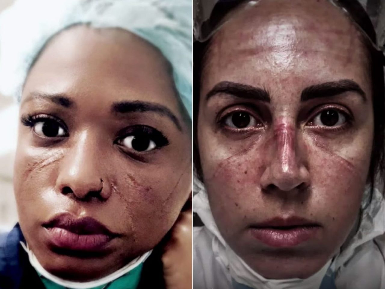 Відвага прекрасна. Dove випустила відео з пошкодженими обличчями медпрацівників